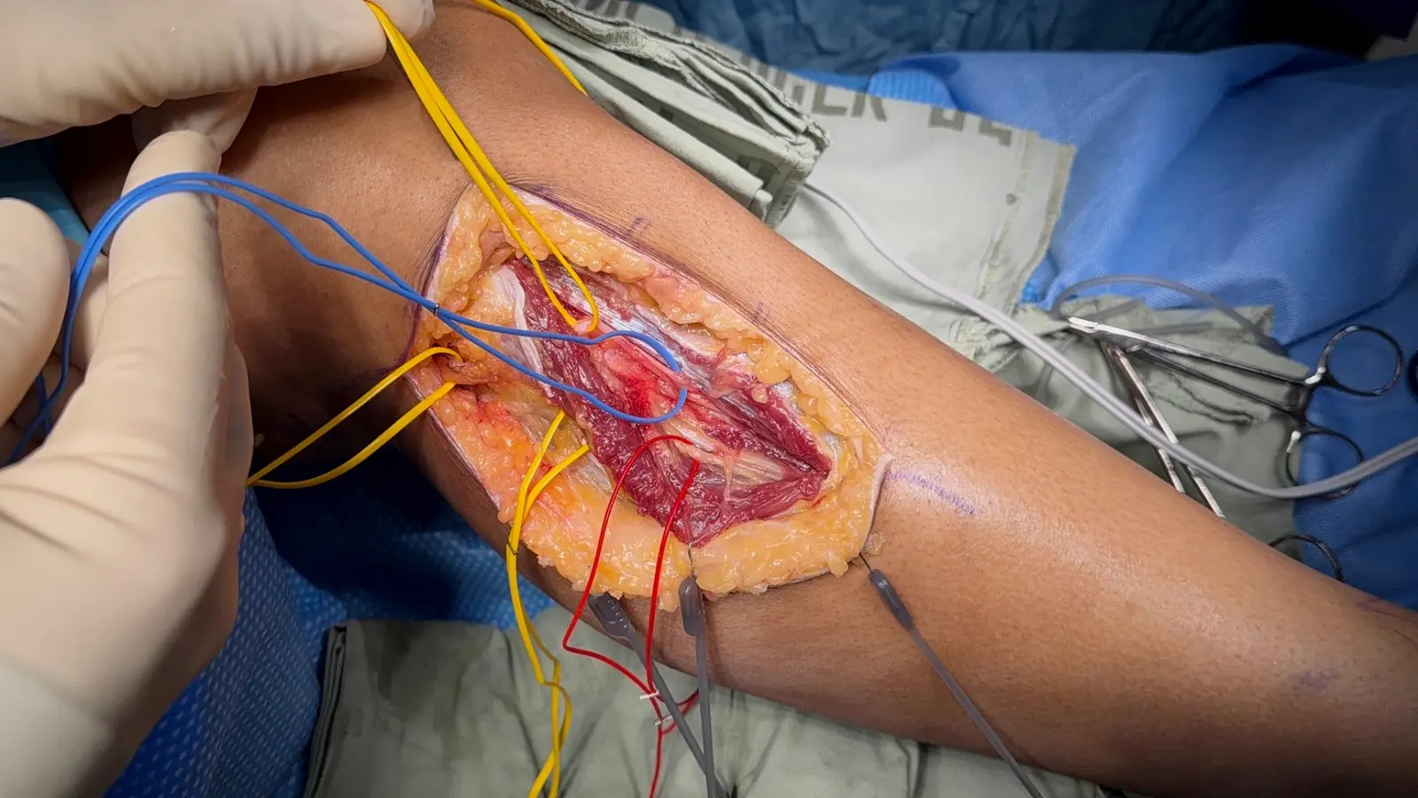Microsurgical exposure of lower-extremity nerves during nerve-transfer planning for foot drop