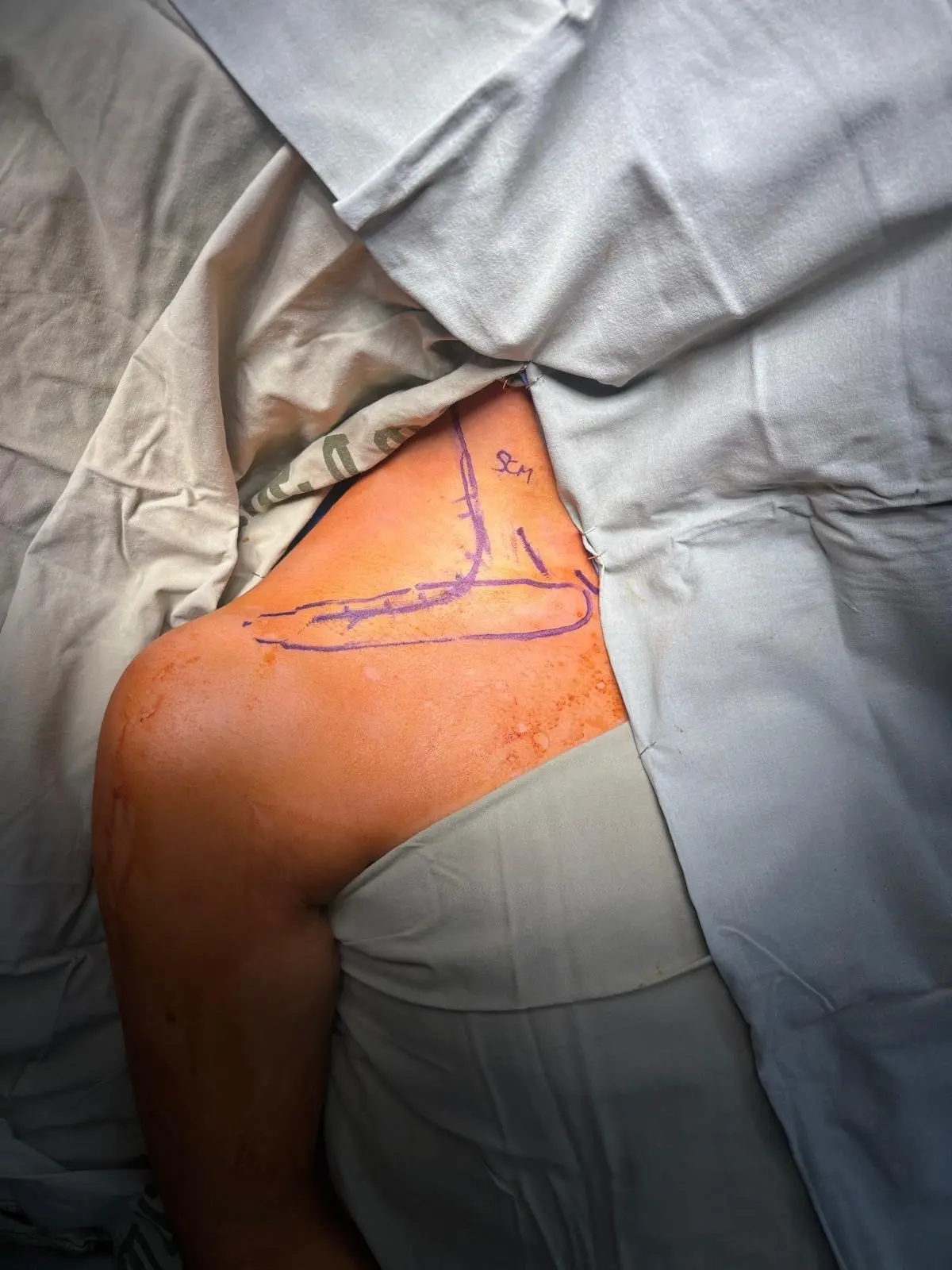 Preoperative marking for thoracic outlet decompression